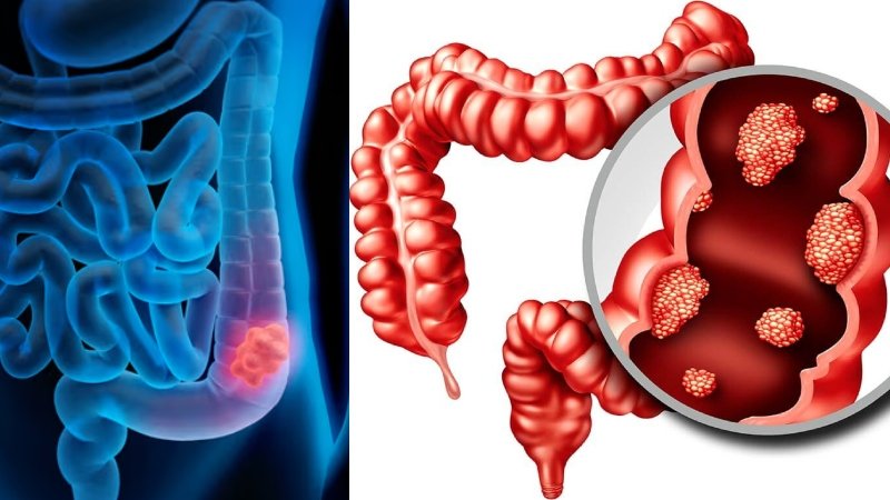 পায়খানায় এই ৪টি লক্ষণ দেখলেই সতর্ক হোন, হতে পারে কোলোরেক্টাল ক্যান্সার!