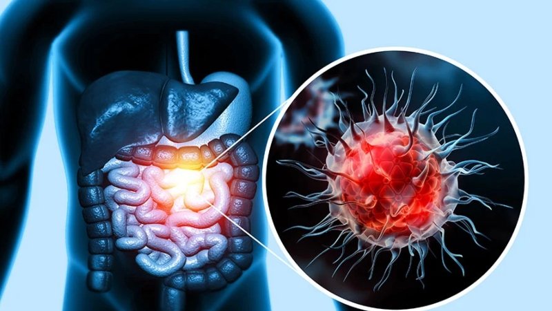 তরুণদের মলদ্বারে বাসা বাঁধছে কোলোরেক্টাল ক্যান্সার! জেনে নিন ৫ সতর্কবার্তা