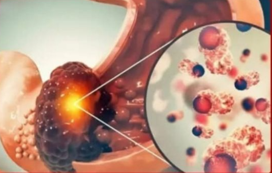 পেটের ক্যা’ন্সারের ৫টি ভয়ংকর ধরণ, যা দ্রুত ছড়িয়ে পড়ে