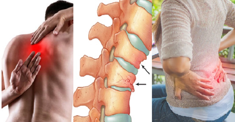 যে ভিটামিনের অভাবে পিঠ ও কোমরে ব্যথা কঠিন যেসব রোগের লক্ষণ হতে পারে