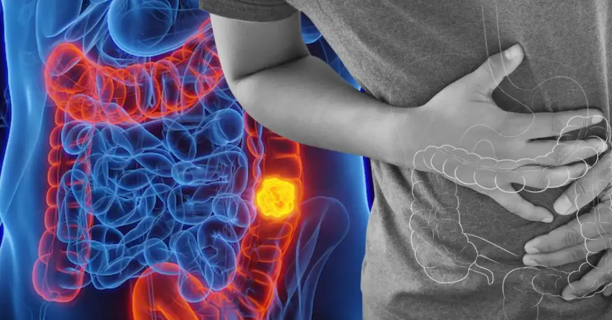 তরুণদের মলদ্বারে বাসা বাঁধছে কোলোরেক্টাল ক্যান্সার! জেনে নিন ৫ সতর্কবার্তা